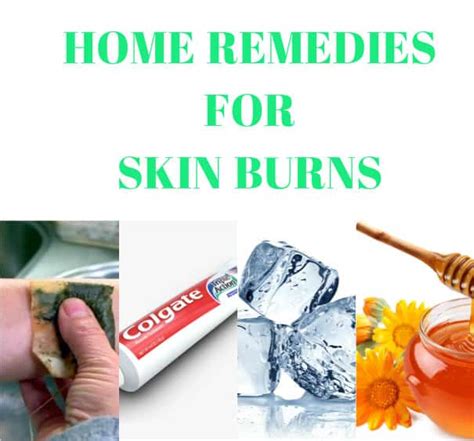 7 Surprising Home Remedies To Heal Skin Burns - Indian Beauty Tips