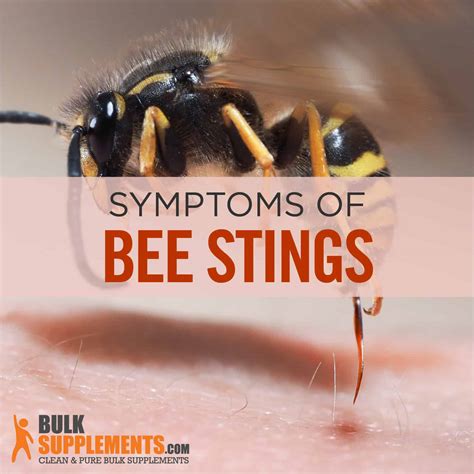 Bee Sting Treatments: What To Know, 49% OFF