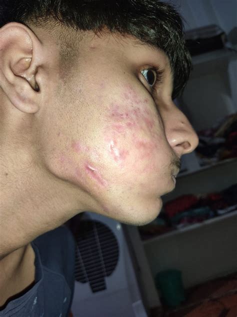 M17 Please help what type of scars are these and there is volume loss ...