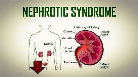 What is Nephrotic Syndrome, Signs & Symptoms, Causes, Diagnosis, and ...