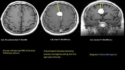 Meningioma falcine and parasagittal