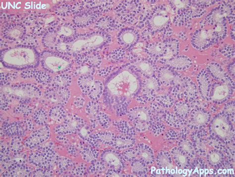 adenoma parathyroid histology