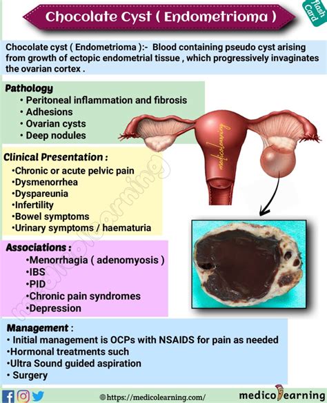 Chocolate Cyst In Endometriosis at Latisha Compton blog