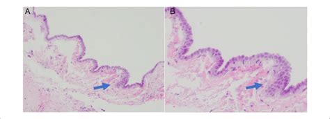 Anatomic pathology after pericardial window. Pericardial tissue with ...