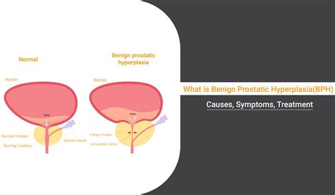 Benign Prostatic Hyperplasia (BPH): Causes, Symptoms, and Treatment