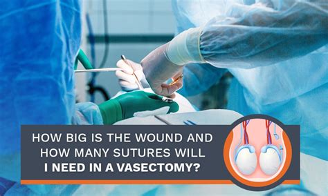 How Many Sutures Will I Need in a Vasectomy? | Clinic Vasectomy