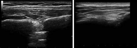 Ultrasound image depicting unilateral rhomboid intercostal and... | Download Scientific Diagram