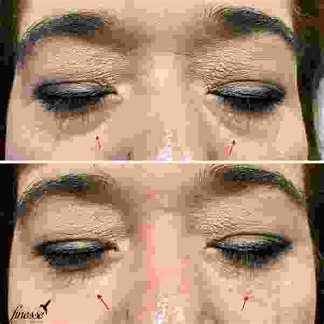 Botox Under Eyes Images (2) » Facial Injections: Info, Prices, Photos ...