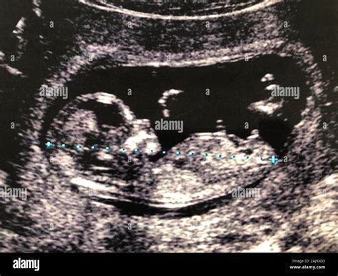 4 month fetus hi-res stock photography and images - Alamy