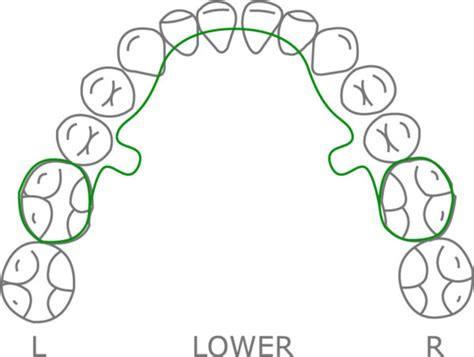 Lingual Arch with Adjustment Loops - Orthodontic Resource Group