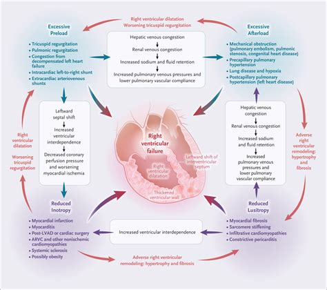 Right Ventricular Failure | NEJM