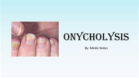 Onycholysis/ Plummer's nail causes and pathophysiology - YouTube