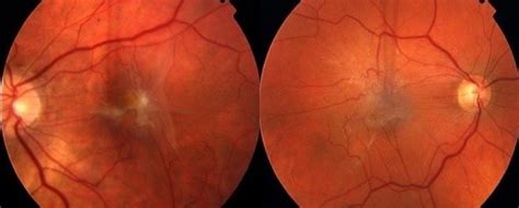 Epiretinal Membrane - Retina & Eye Consultants