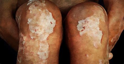 9 Common Triggers Of Psoriasis Flare-Ups | Psoriasis, Psoriasis treatment, Flares