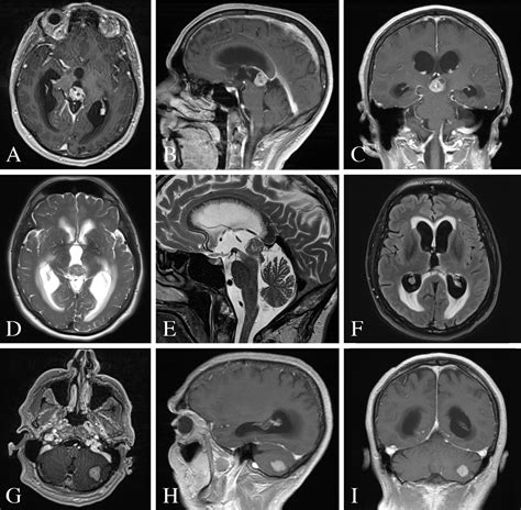 Frontiers | Pineal Gland Metastasis From Poorly Differentiated Carcinoma of Unknown Primary Origin