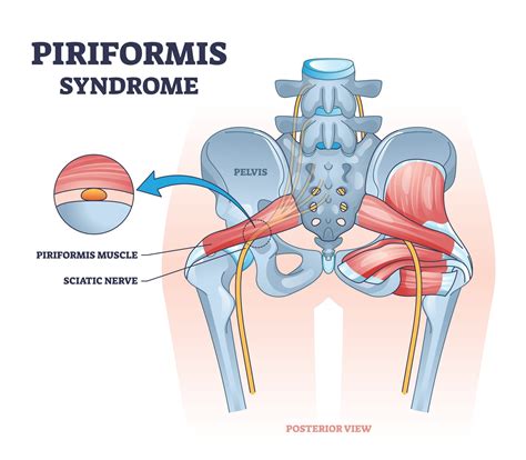 Piriformis Syndrome - Steps to Improve Sleep - Health Works Collective