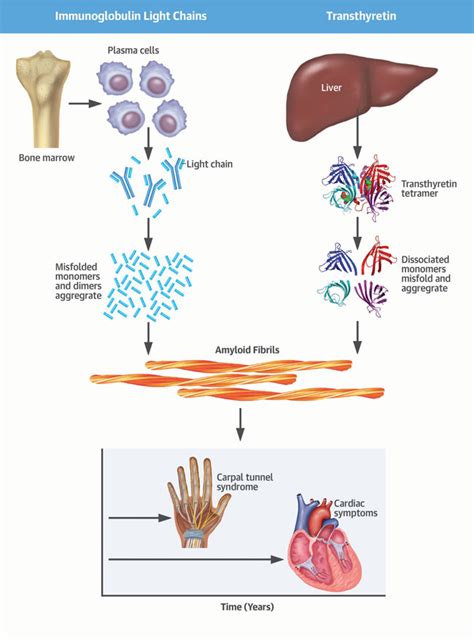 Types Of Amyloidosis