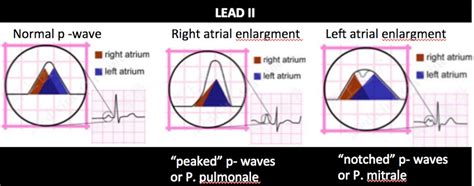 EKG – 4 – Atrial Enlargement – EMHUM