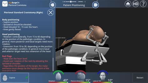 pterional craniotomy - | Image search, Search, Medical