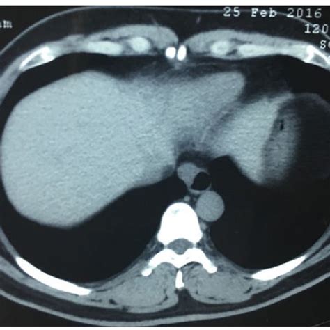 CT demonstrated a soft-tissue attenuation mass from the distal ...