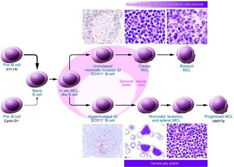 Mantle cell lymphoma symptoms, diagnosis, prognosis and treatment