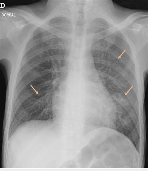 Chest X-ray showing bilateral interstitial infiltrates (arrows). | Download Scientific Diagram