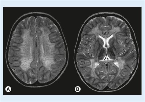 MRI in juvenile metachromatic leukodystrophy. (A) The central white... | Download Scientific Diagram