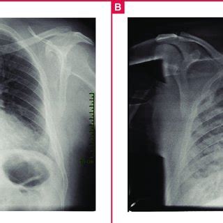 Anterior-posterior chest X-ray. A: At presentation showing enlargement... | Download Scientific ...