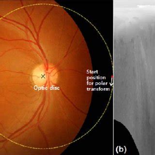 Clock-hour locations of RNFL defects on fundus photographs of the (a)... | Download Scientific ...