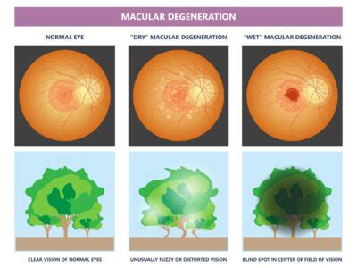 What to Expect During a Macular Degeneration Test