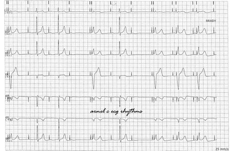 ECG Rhythms: Managed Ventricular Pacing