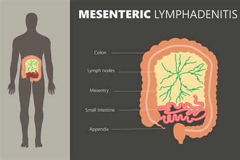 Calendario 2023 Pdf Mesenteric Lymphadenitis Vs Appendicitis Surgery ...