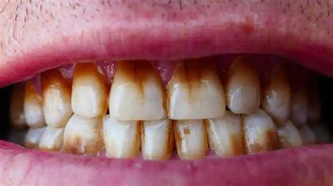 How To Remove Tobacco Stains From Teeth Instantly