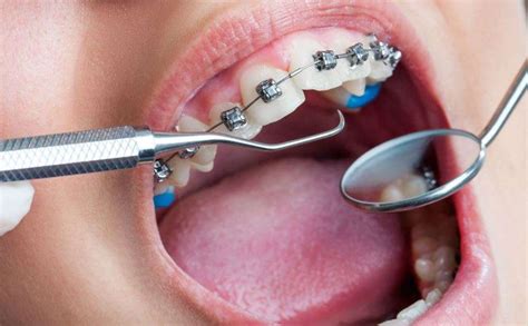 سعر تقويم الأسنان الفك العلوي فقط في مصر - Capital Dental Clinic