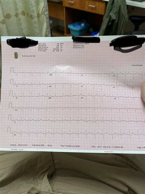 I think I may have found a J wave on my ecg? Is this correct? : r/ems