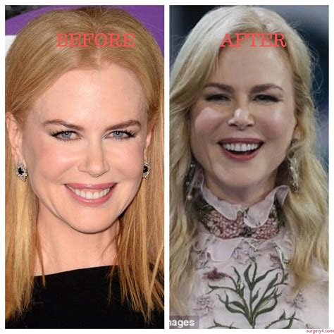 Nicole Kidman Plastic Surgery Photos [Before & After] ⋆ Surgery4