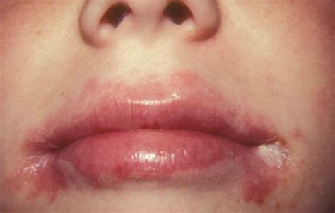 12 Natural Treatments for Angular Cheilitis