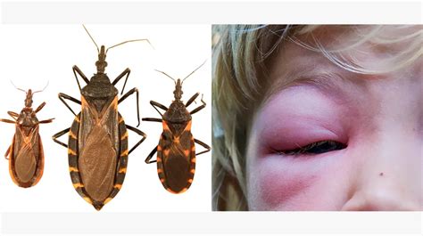 Understanding Bug Bites: Types, Symptoms, and Treatment