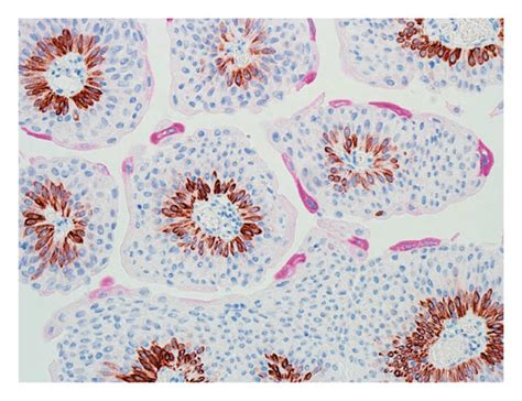 (a) Low-grade papillary urothelial carcinoma. (b) Immunohistochemical ...