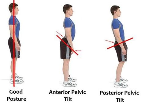 Posterior Pelvic Tilt : Cause, Symptom, Treatment, Physiotherapy Exercise