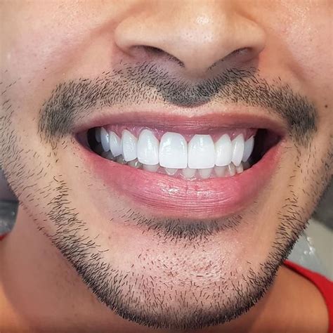 Porcelain Veneers on Harley Street | Pro Dental Clinic