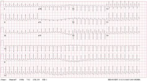 Các bất thường trên ECG: