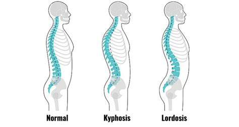 Hyperlordosis - Signs, Causes and Corrective Exercises