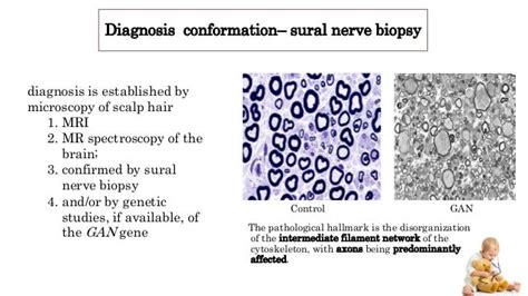 Giant axonal neuropathy