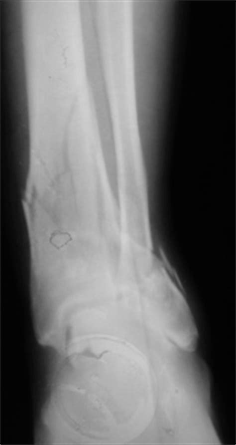 Tibial Plafond Fracture Anatomy