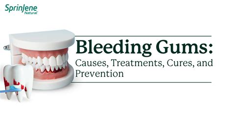 Bleeding Gums: Causes, Treatments, Cures and Prevention – Sprinjene