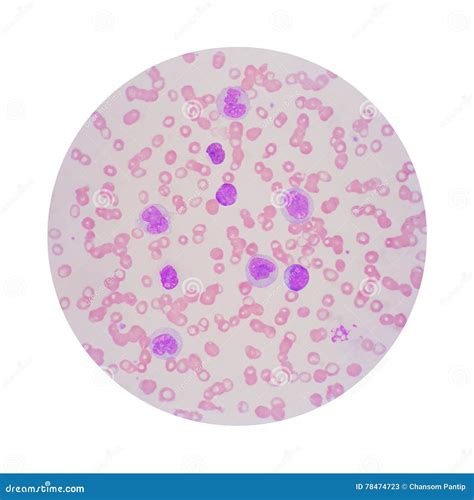 Microscopic View of a Blood Smear from Leukemia Patient Showing Stock Image - Image of leukocyte ...