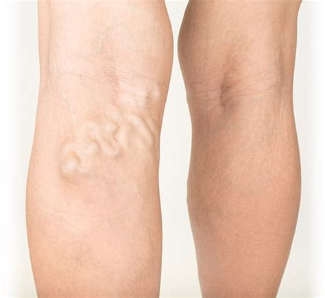 Varicose Veins - Symptoms, Causes & Conditions | Vein Health