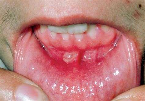 White Spots On Gums Cancer