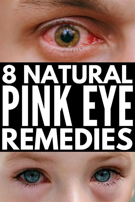 Pin by cameronkb3jl0 on Health | Natural pink eye remedy, Pinkeye remedies, Pink eyes